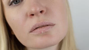 Jak walczyć z suchymi ustami?