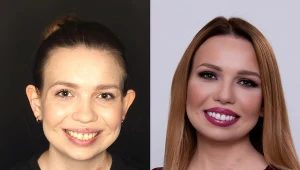 Pani Marta miała kompleksy ze względu na krzywe zęby. Dr Emma przywróciła jej piękny uśmiech