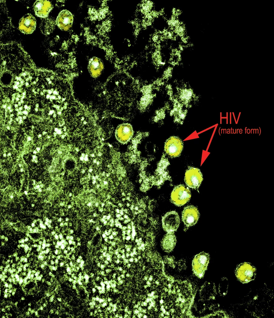 Wirus HIV-1 widziany przez transmisyjny mikroskop elektronowy (TEM) /Fot. BSIP/UIG Via Getty Images