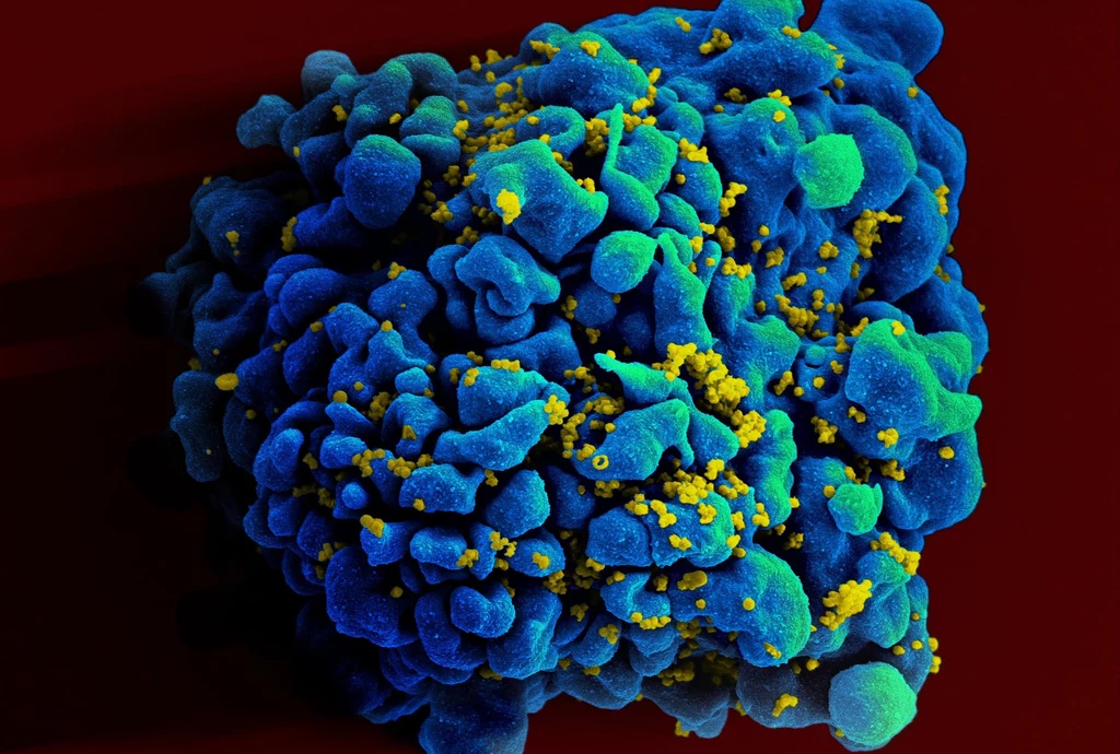 Limfocyt T atakowany przez wirusa HIV-1 - zdjęcie wykonane dzięki skaningowej mikroskopii elektronowej (SEM) /Fot.  IMAGE POINT FR/NIH/NIAID/BSIP/Universal Images Group via Getty Images