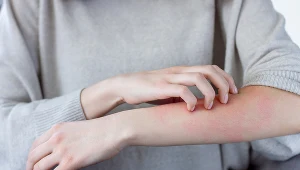 Niektóre produkty mogą nasilać objawy atopowego zapalenia skóry