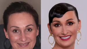 Zęby pani Ewy były poszarzałe przez przyjmowanie suplementów z żelazem w przeszłości