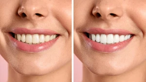 Wiele osób nie jest zadowolonych z koloru swoich zębów. Odpowiadamy na pytanie, co może być przyczyną żółtych zębów