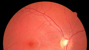 Zwyrodnienie plamki żółtej. Plaga naszych czasów