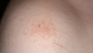 Na zdj. wysypka w mastocytozie u rocznego dziecka