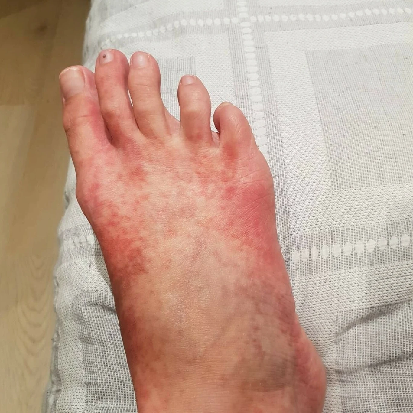 Wysypka w przebiegu mastocytozy u dorosłej kobiety