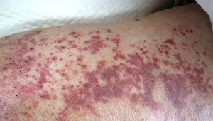 To nie wysypka. Czym są wybroczyny i kiedy powstają?