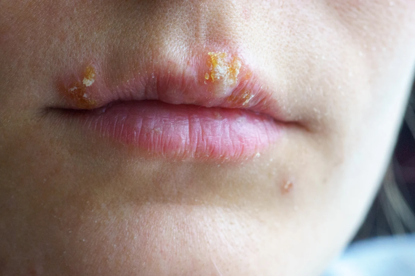 Zimno? Objaw na ustach to jasny sygnał od organizmu - jesteś osłabiony