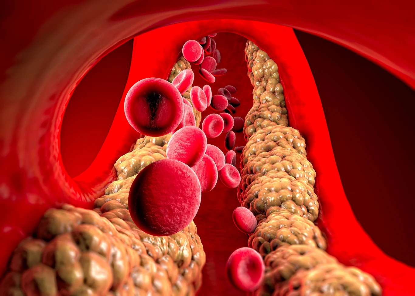 Hipercholesterolemia może wynikać ze złej diety i braku aktywności fizycznej