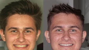 Skazą na równych zębach Mateusza były białe plamy - odwapnienia po aparacie