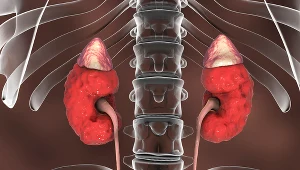 Miliony Polaków cierpią na przewlekłą chorobę nerek. Lata bez objawów