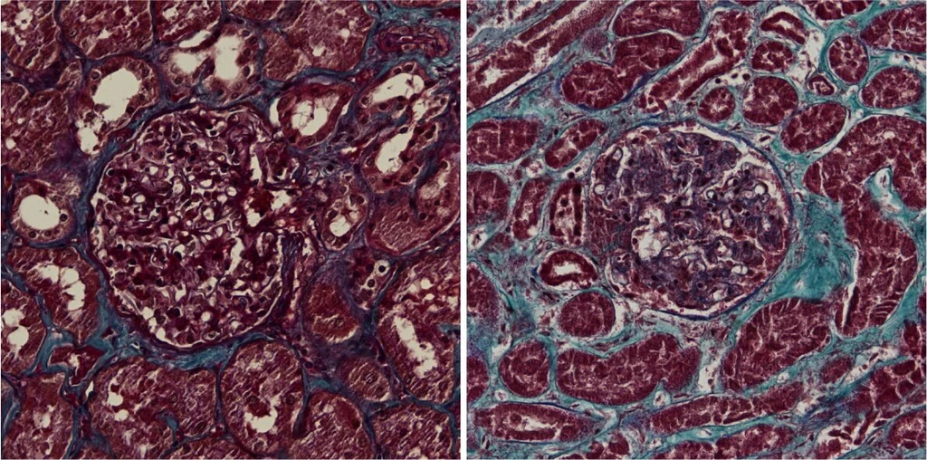 Zdjęcie histologiczne nerek - po lewej tkanka zdrowa, po prawej zmieniona przez SARS-CoV-2 (widoczne liczne zwłóknienia)