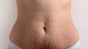 Rozstępy bardzo często są wynikiem przebytej ciąży