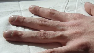 Palce pałeczkowate to m.in. objaw raka płuc, ale też np. raka żołądka czy przełyku