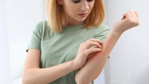 Ślady zaburzenia widać na skórze. Ale dermatolog kieruje ich do psychiatry