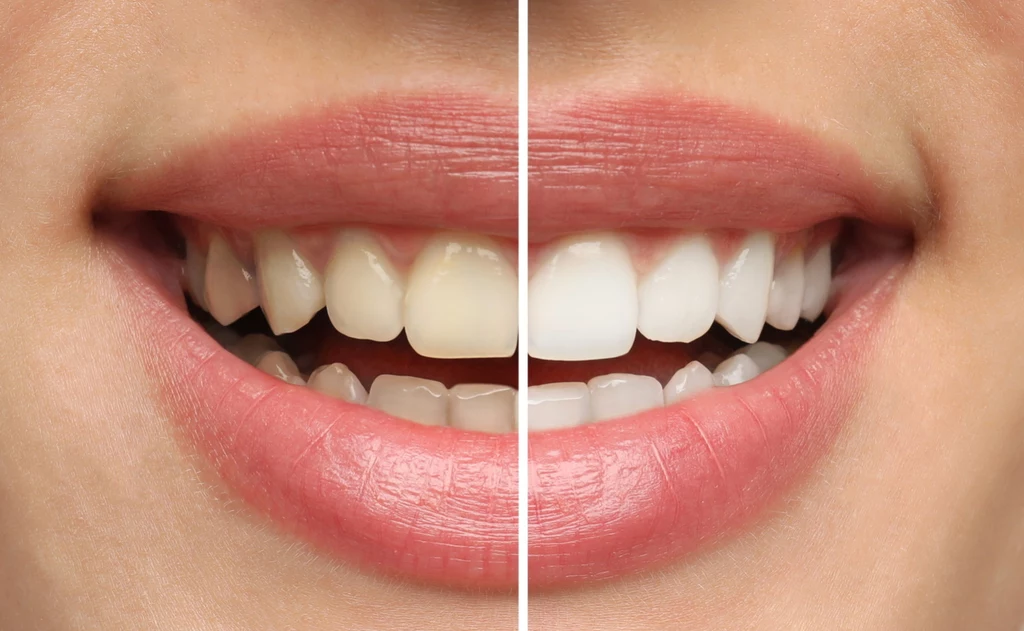 Jeśli chcemy cieszyć zdrowym uśmiechem, konieczne jest dbanie o prawidłową higienę jamy ustnej – pomocne z pewnością okażą się przeróżne preparaty i produkty wybielające 