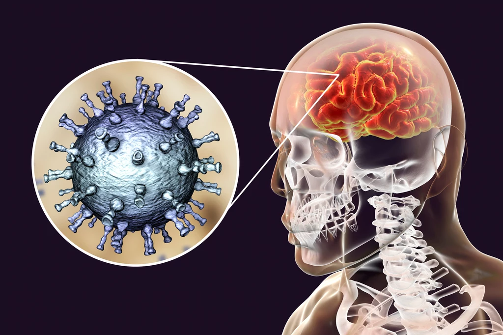 Po przebyciu ospy wietrznej, VZV pozostaje uśpiony w mózgu człowieka, skąd może ponownie zaatakować