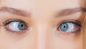 Zez u dzieci może być wynikiem urazów porodowych. U dorosłych wada ta może mieć związek ze zmianami chorobowymi