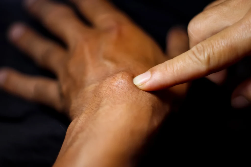 Nadwyrężenie i stan zapalny w stawie powodują pojawienie się torbieli zwanej ganglionem Nadwyrężenie i stan zapalny w stawie powodują pojawienie się torbieli zwanej ganglionem