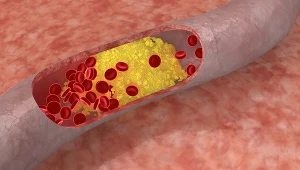 Hipercholesterolemia. Objawy podwyższonego cholesterolu