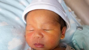 Zażółcenie skóry w wyniku żółtaczki fizjologicznej występuje u prawie 40 proc. zdrowych noworodków