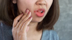 Pękające wargi to znak, że w organizmie brakuje ważnych witamin i mikroelementów 