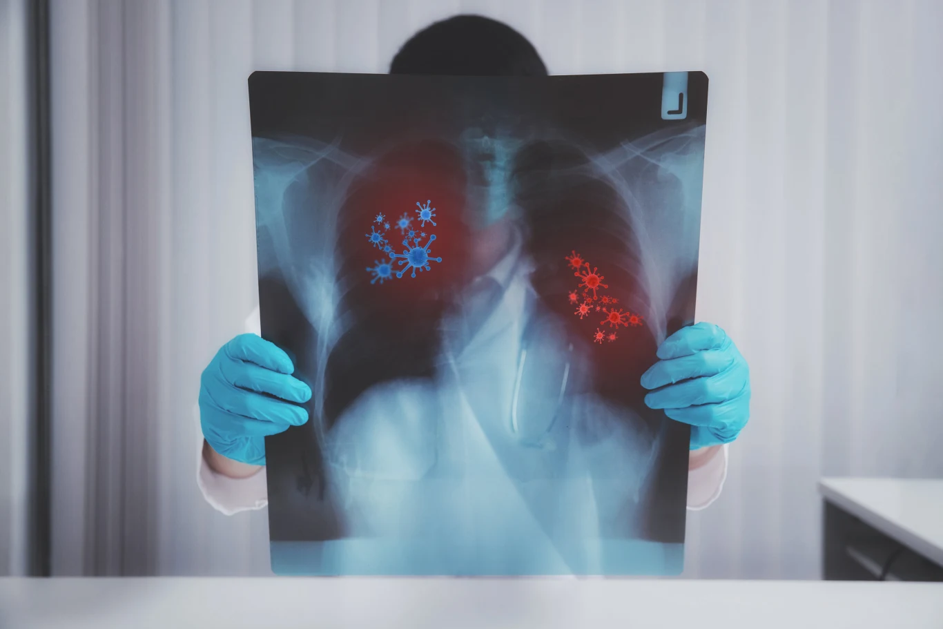 Diagnostyka grzybicy płuc wymaga badań obrazowych i pobrania wymazu do badań 
