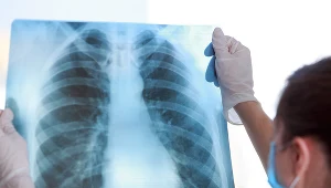 Odma opłucnowa. Poznasz ją po dusznościach i bladej cerze