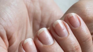 Poprzeczne lub podłużne bruzdy na paznokciach to znak wielu poważnych schorzeń