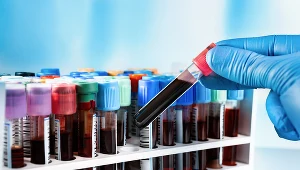 Niedobór witaminy B12 – niedokrwistość megaloblastyczna 