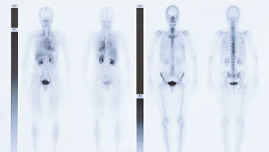 Scyntygram całego ciała