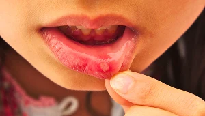 Przyczyną powstawania aft jest m.in. stosowanie antybiotykoterapii, alergie, silny stres i obniżona odporność