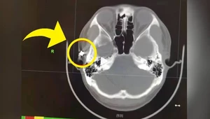 Lekarze mówią o cudzie. Nie do wiary, co znaleźli w jego czaszce