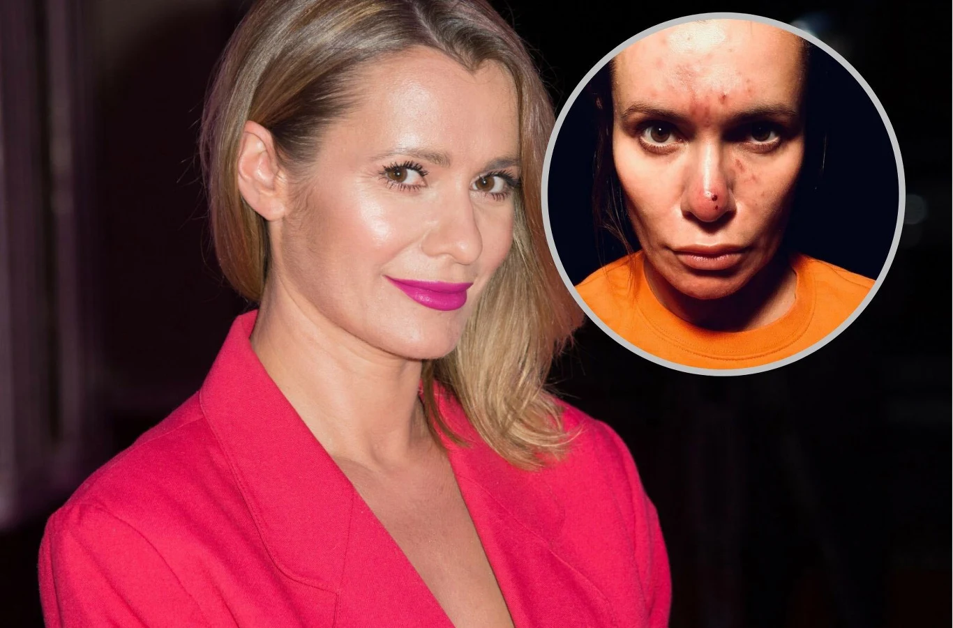 Anna Oberc zmaga się z trądzikiem. Przez chorobę straciła pracę Anna Oberc zmaga się z trądzikiem. Przez chorobę straciła pracę