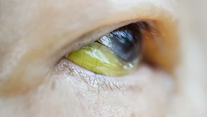 W żółtaczce jako pierwsze zabarwiają się białkówki oka, a następnie skóra