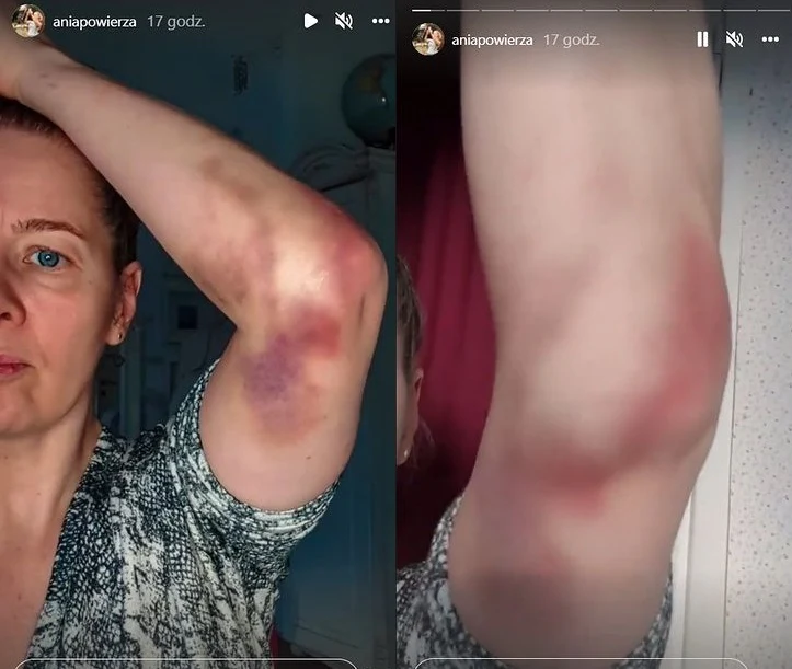 Powierza pożaliła się fanom /https://www.instagram.com/aniapowierza/ Powierza pożaliła się fanom /https://www.instagram.com/aniapowierza/