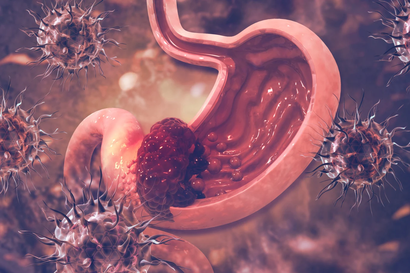 Rak żołądka przez długi czas może nie dawać żadnych objawów Rak żołądka przez długi czas może nie dawać żadnych objawów