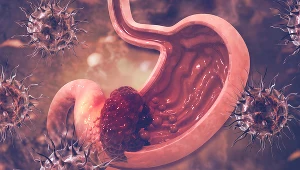 Rak żołądka przez długi czas może nie dawać żadnych objawów