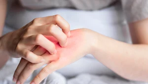 Objawem egzemy są swędzące, lekko pęcherzykowe, najczęściej występujące na rękach lub nogach