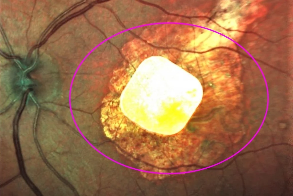 Oko pacjenta z wszczepionym implantem