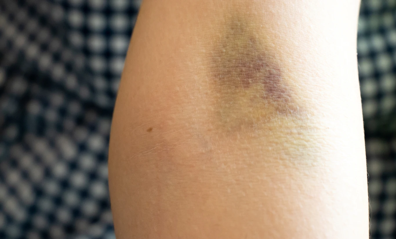 Na ryzyko powstawania siniaków są narażone kobiety podczas miesiączki oraz osoby przyjmujące leki rozrzedzające krew Na ryzyko powstawania siniaków są narażone kobiety podczas miesiączki oraz osoby przyjmujące leki rozrzedzające krew