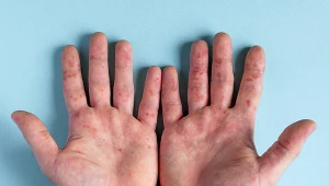 Bostonka – zakaźna choroba u dzieci