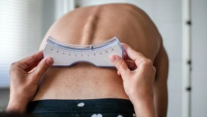 Niedobór witaminy D prowadzi do krzywicy. Choroba ma groźne konsekwencje