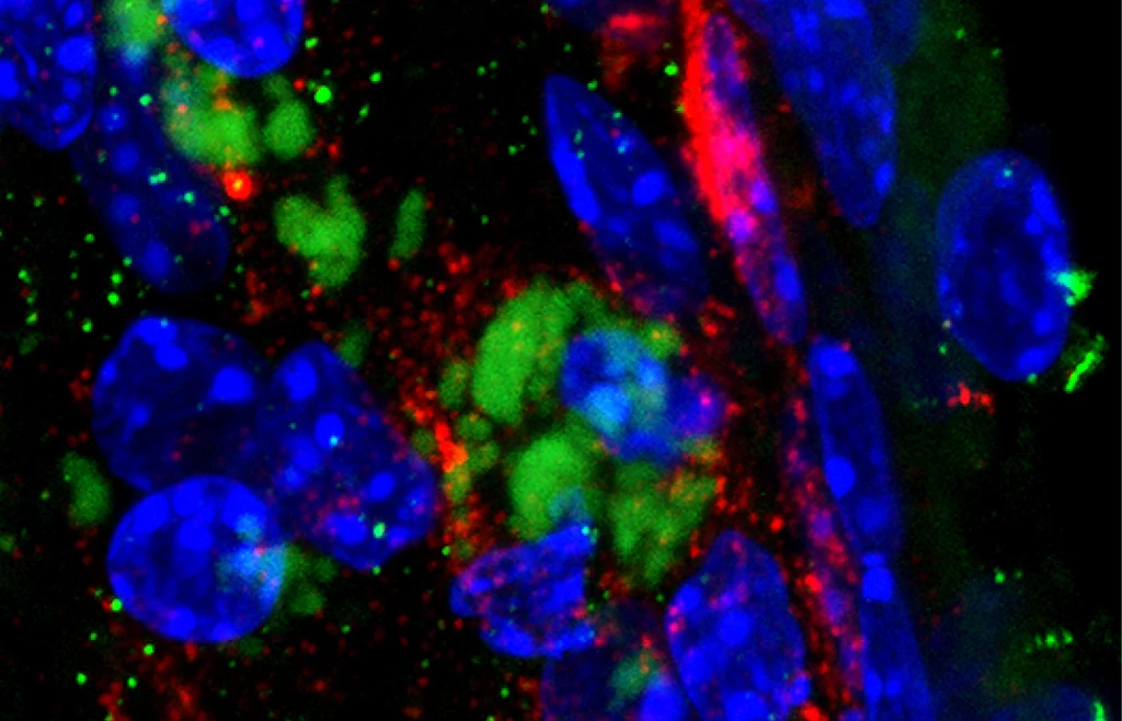 Bakteria Chlamydia pneumoniae (zielony) w rejonie opuszki węchowej w przedniej części mózgu. Amyloid beta (czerwony) gromadzi się wokół bakterii