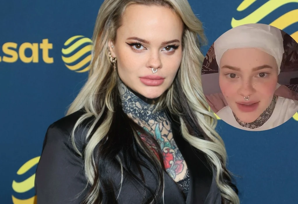 Monika Miller po przeszczepie włosów