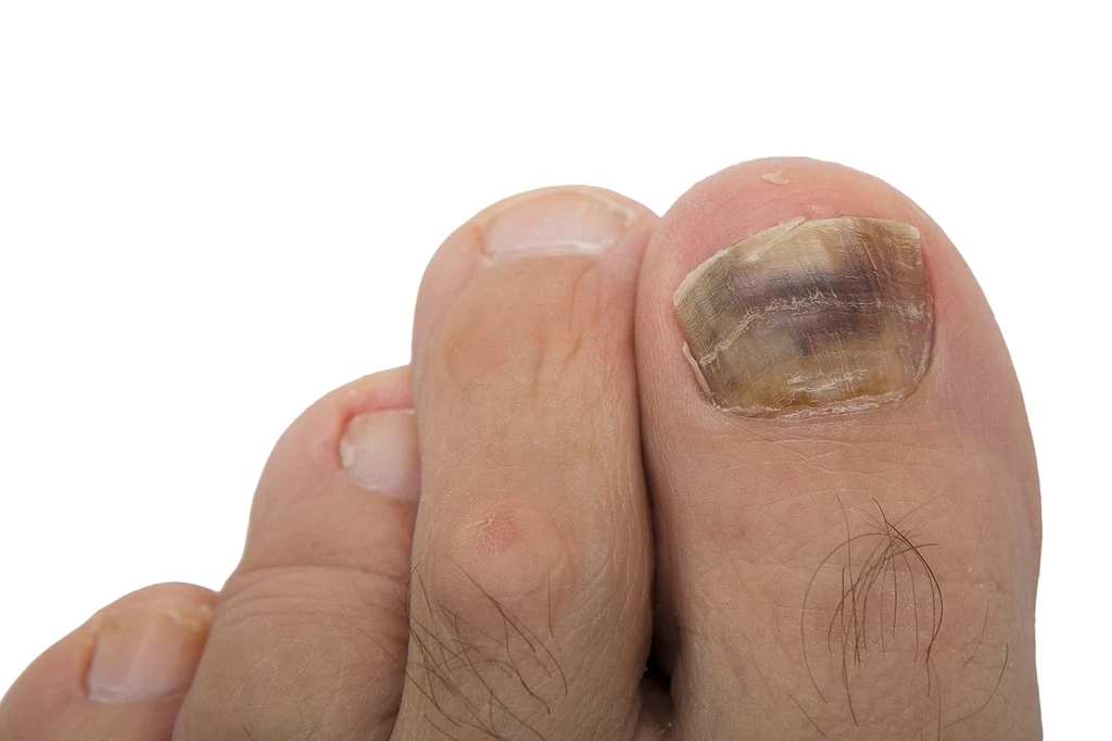 Krwiak może być efektem zbitego paznokcia lub grzybicy