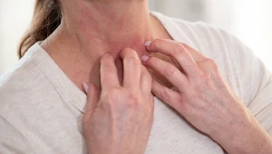 Uporczywy świąd skóry? To może być objaw niedoboru witaminy D