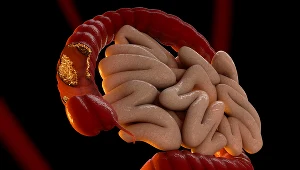 Zespół Lyncha - nowotwór zapisany w genach