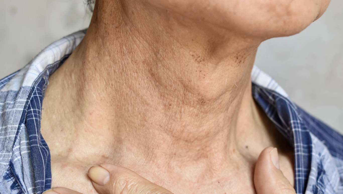 Zmarszczki na szyi i dekolcie mogą powstawać na skutek palenia papierosów oraz promieniowania UV.
