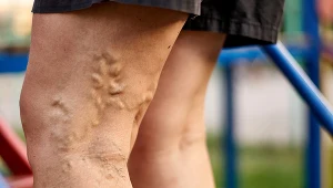 Heparyna stosowana jest w leczeniu choroby zakrzepowo-zatorowej objawiającej się bólem i obrzękiem nóg